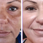 Prescription Dark Spot Cream Offers Hope After OTC Serums Fail